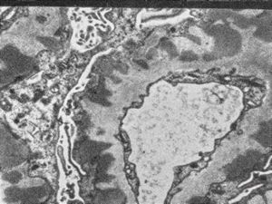 F,74y. | membranous glomerulopathy